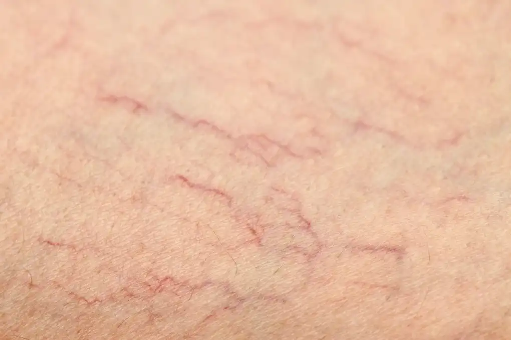 What are spider veins?