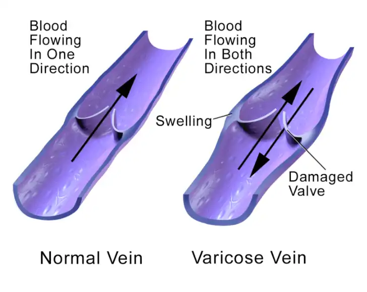 What are varicose veins?