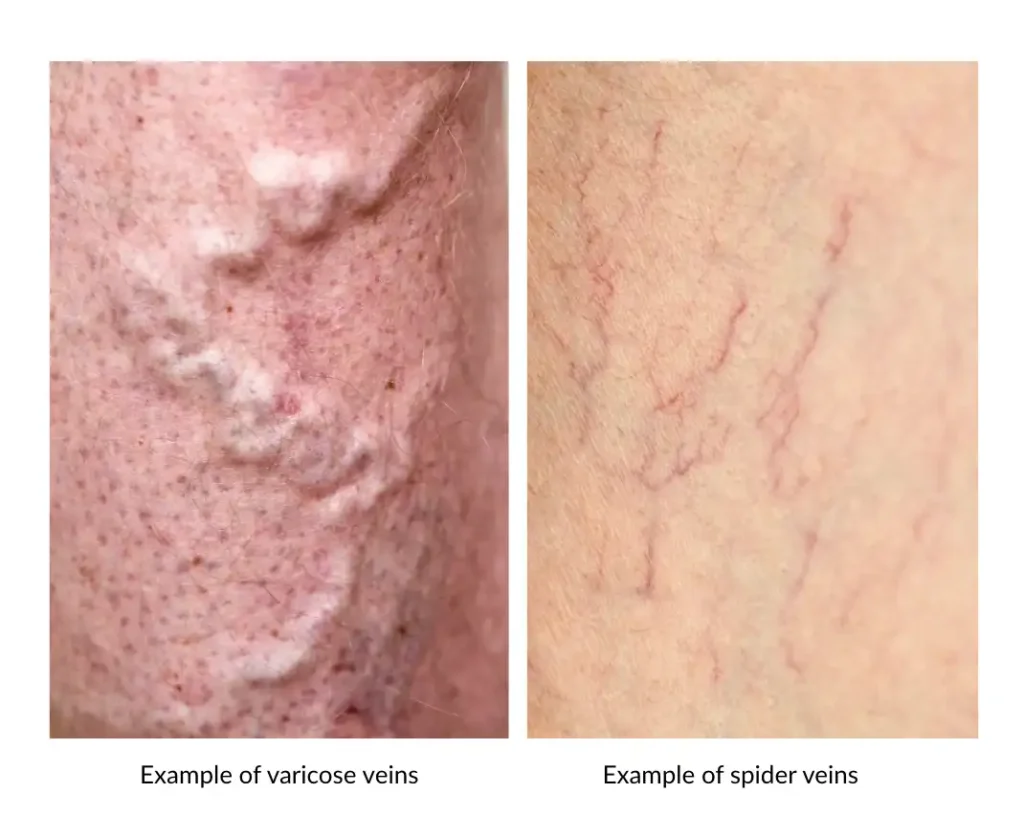 Key differences between varicose veins and spider veins