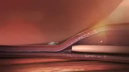 VenaSeal for Varicose Veins