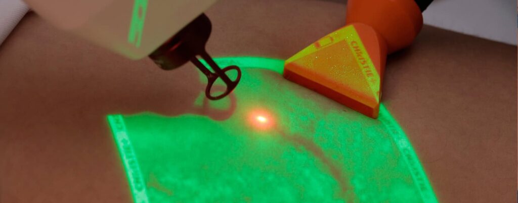 CLaCS treatment for spider veins