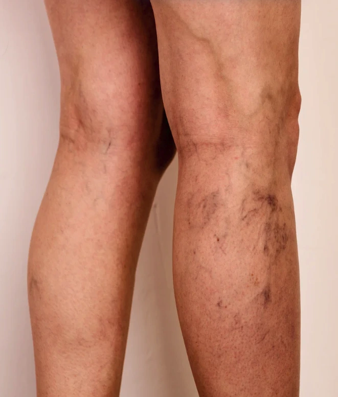Varicose Veins Specialists in Singapore