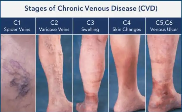 6 Stages of Chronic Venous Insufficiency