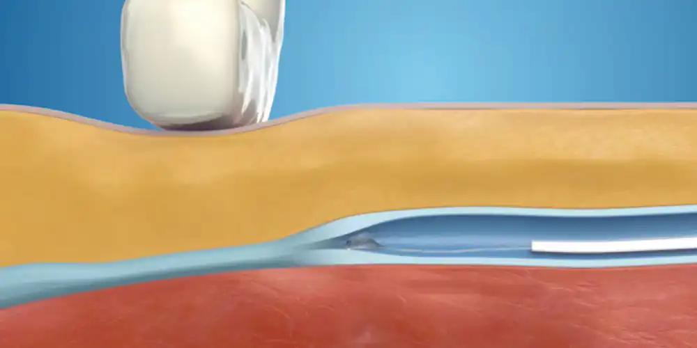 VenaSeal for Varicose Veins