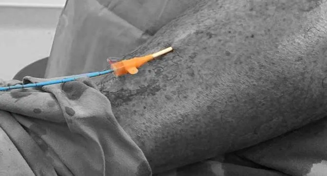 Single Puncture approach to Varicose Veins