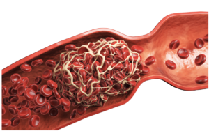 Deep Vein Thrombosis (DVT) Singapore