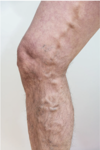 7 common myths about varicose veins