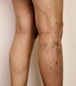 7 common myths about varicose veins