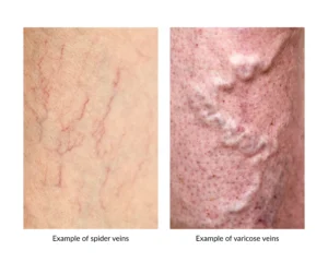 varicose veins myths