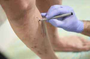 Chronic Venous Insufficiency: A Singapore Patient’s Guide