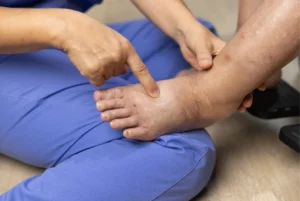 Chronic Venous Insufficiency: A Singapore Patient’s Guide