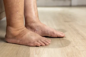 Chronic Venous Insufficiency: A Singapore Patient’s Guide