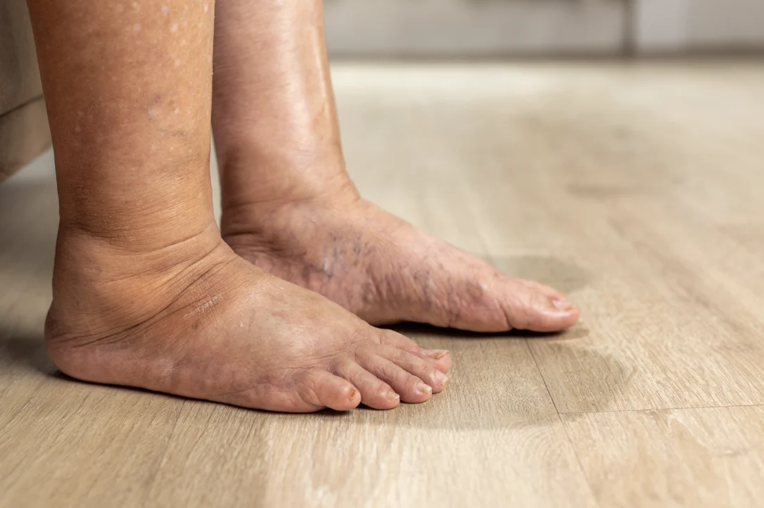 Chronic Venous Insufficiency: A Singapore Patient’s Guide