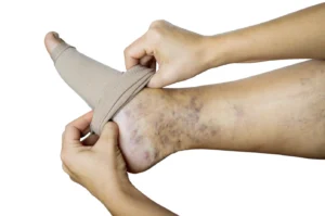 Guide to Compression Socks for Better Vein Health