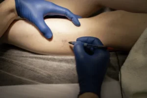 Close-up of fine needle treatment during a sclerotherapy session.