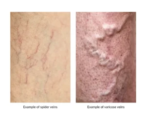 Visual guide showing spider veins and severe varicose veins suitable for sclerotherapy.