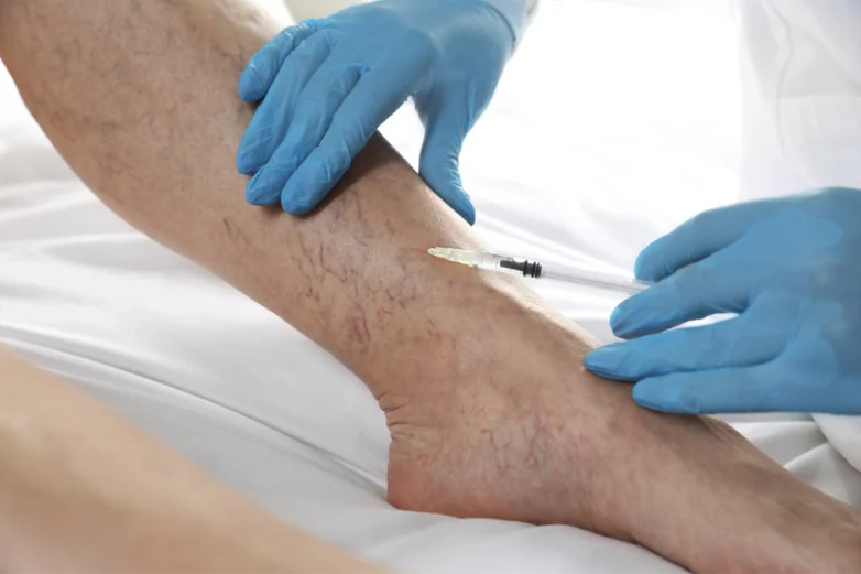 Doctor administering sclerotherapy injection into leg veins.