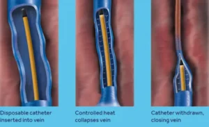 Illustration demonstrating the process of radiofrequency ablation collapsing a diseased vein.
