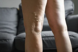Specialist using ultrasound guidance for minimally invasive varicose vein surgery.
