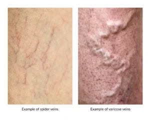 Side-by-side comparison chart illustrating fine red spider veins vs thick bulging varicose veins for medical diagnosis and spider veins treatment in Singapore.
