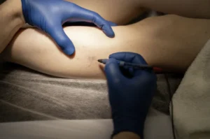 Medical practitioner in blue gloves performing a targeted spider veins treatment in Singapore using a fine-needle electrocautery or sclerotherapy device on a leg.