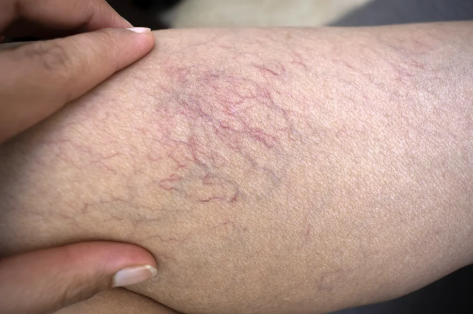 Close-up of a person's leg showing a cluster of fine, reddish-purple web-like veins requiring spider veins treatment in Singapore.