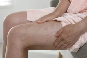 Patient sitting down and inspecting visible varicose veins on their legs before choosing between surgery and minimally invasive treatment.