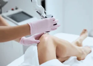 Practitioner applying a laser device to a patient's leg to address the question does laser really work on spider veins.