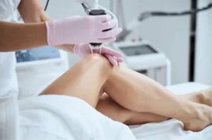 Close-up of a leg laser treatment session evaluating does laser really work on spider veins.