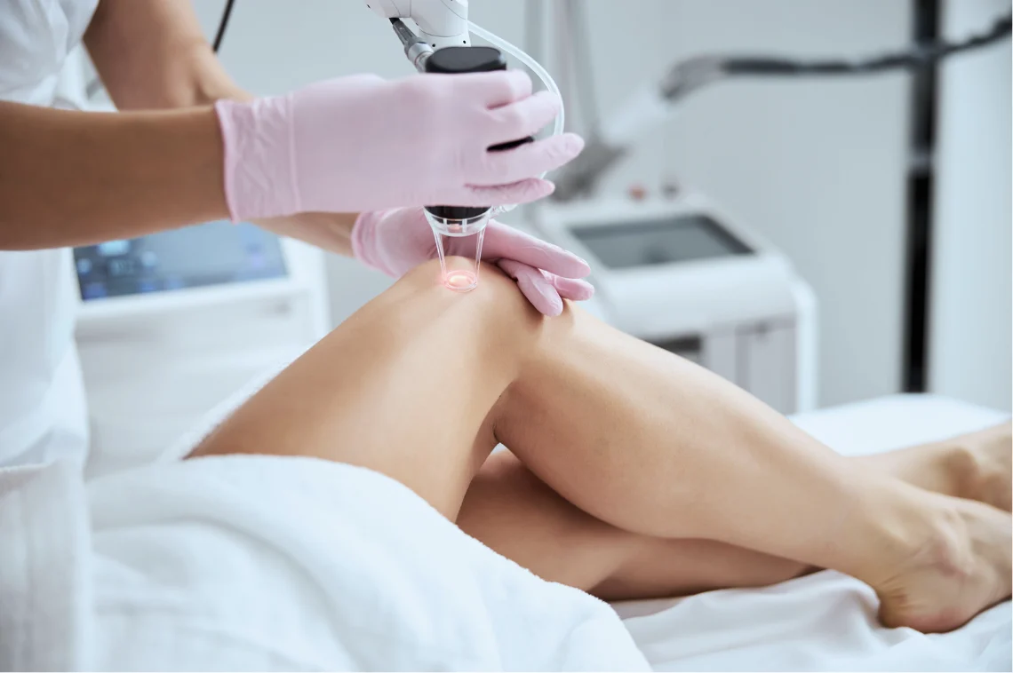 Close-up of a leg laser treatment session evaluating does laser really work on spider veins.