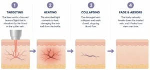 Step-by-step diagram showing targeting, heating, collapsing, and absorption to explain how does laser really work on spider veins.