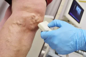 Doctor conducting an ultrasound scan on a patient's leg to assess venous insufficiency and bleeding varicose veins in legs.