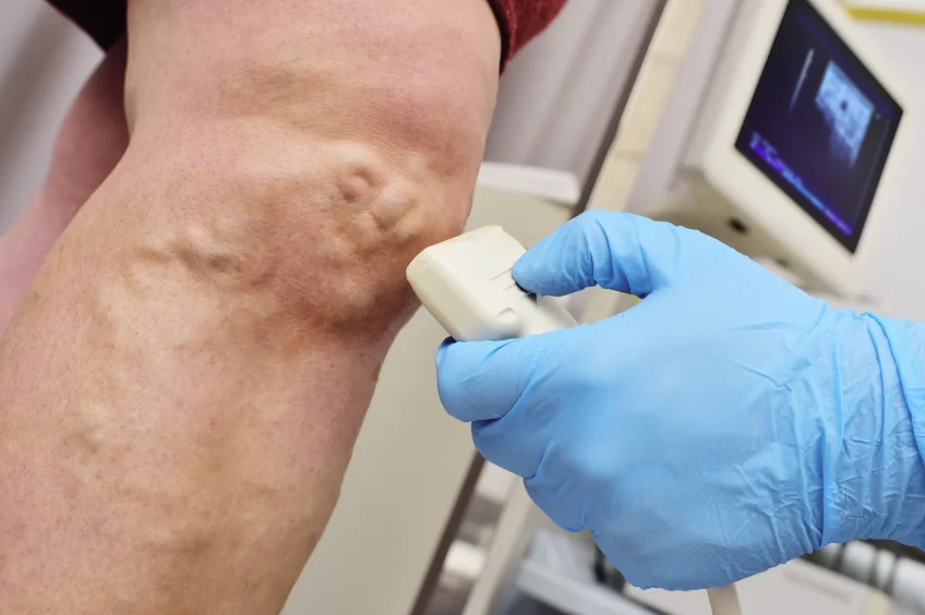 Doctor conducting an ultrasound scan on a patient's leg to assess venous insufficiency and bleeding varicose veins in legs.